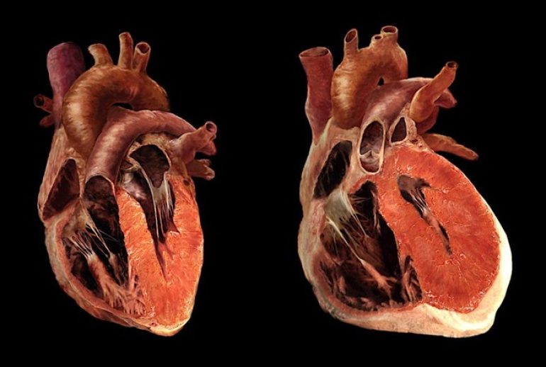 دکتر بزرگ شدن قلب یا کاردیومگالی - بندرعباس