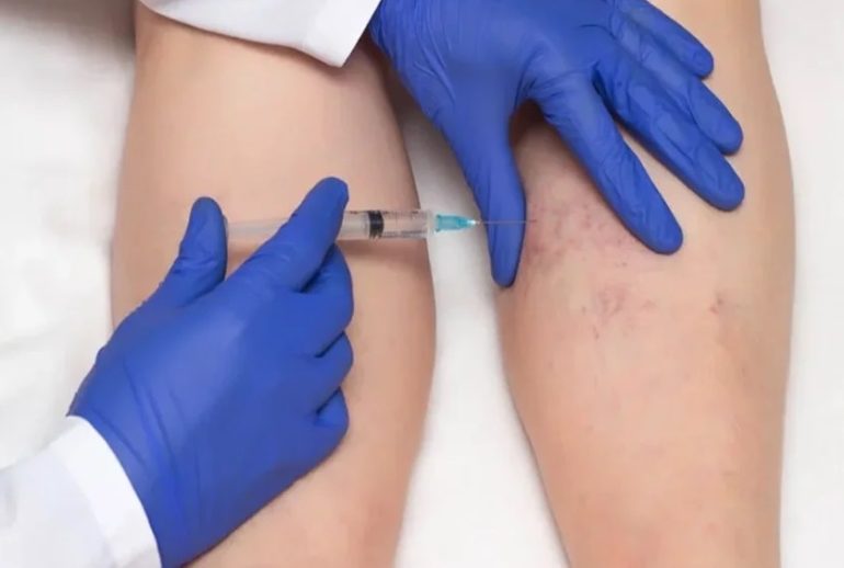 دکتر ناهنجاری های عروقی (اسکلروتراپی) - کرج